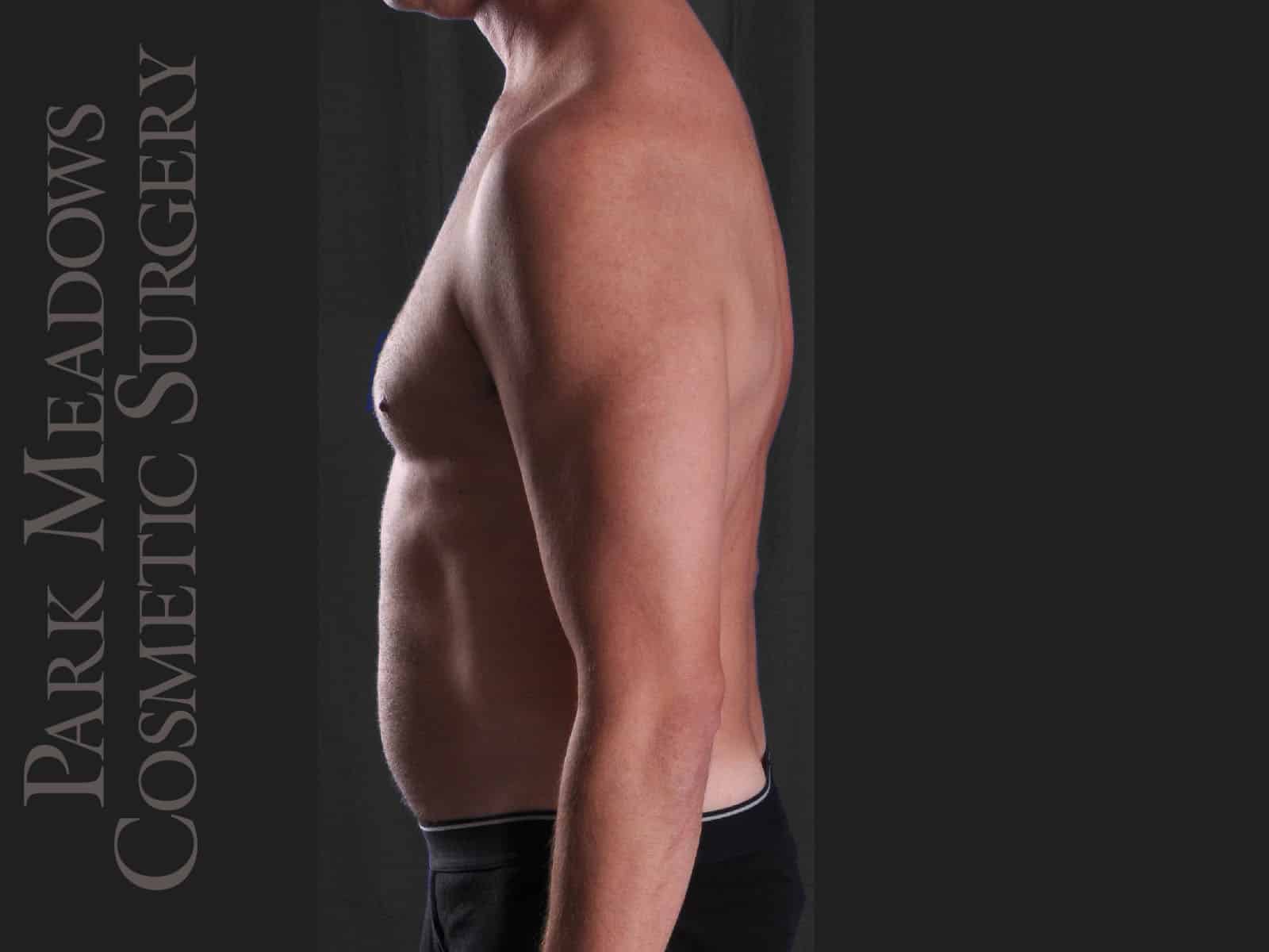 Before Image: Liposuction - left-side