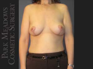 Mastopexy (Breast lift)