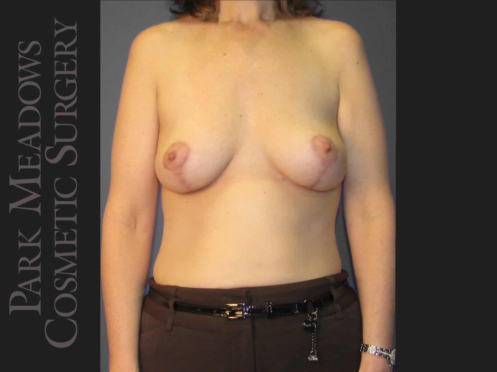 After Image: Mastopexy (Breast lift) - front