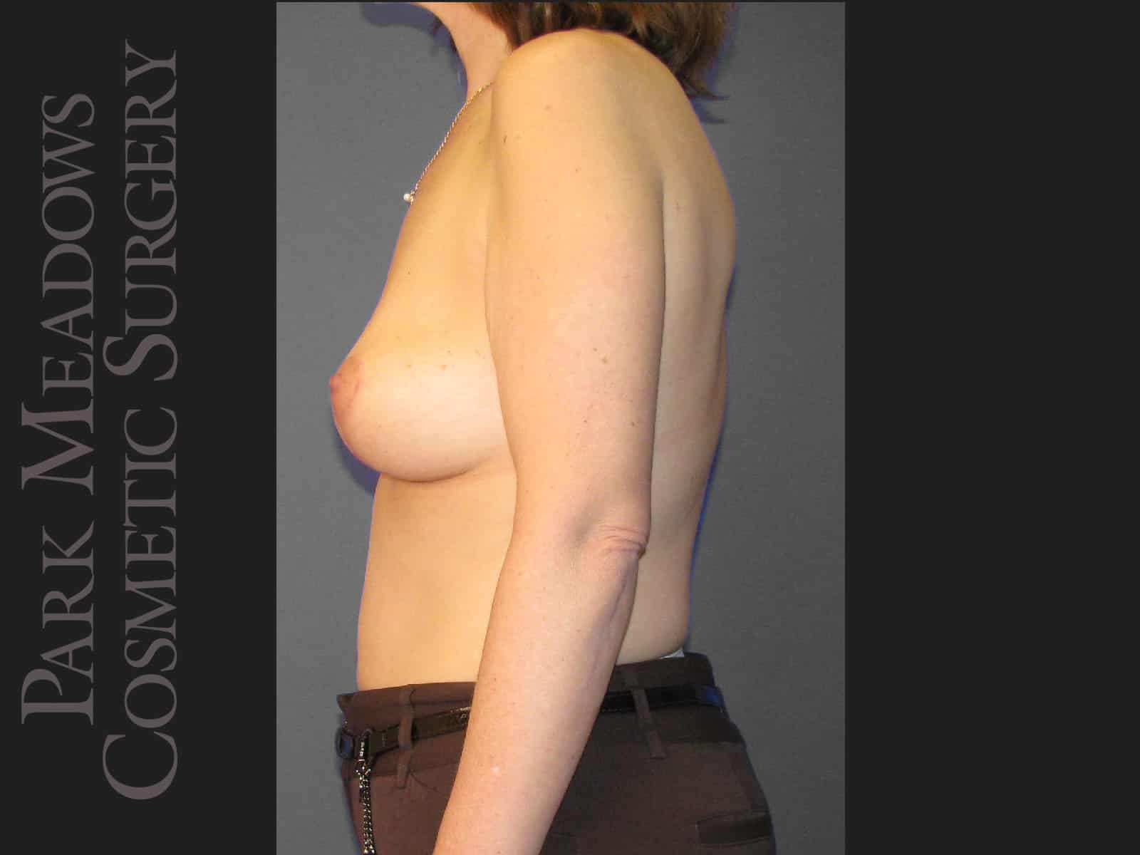 After Image: Mastopexy (Breast lift) - left-side