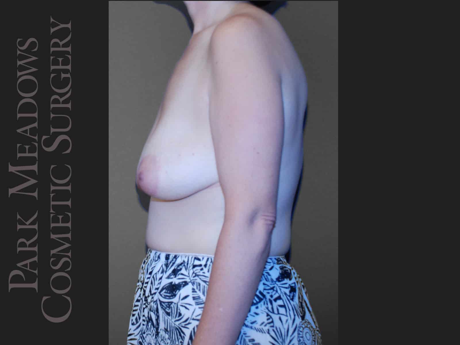 Before Image: Mastopexy (Breast lift) - left-side
