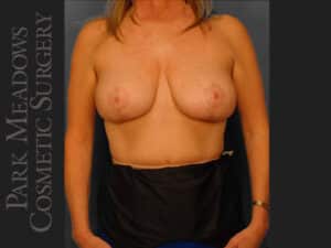 Mastopexy (Breast lift)