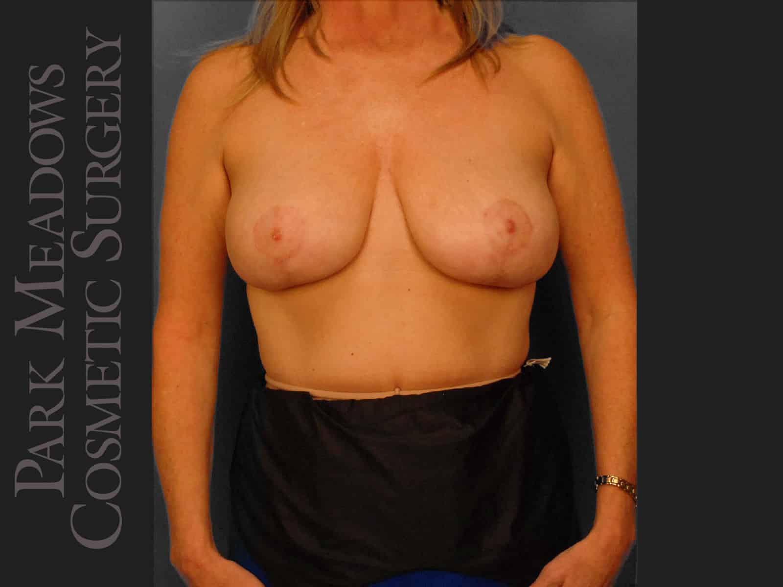 After Image: Mastopexy (Breast lift) - front