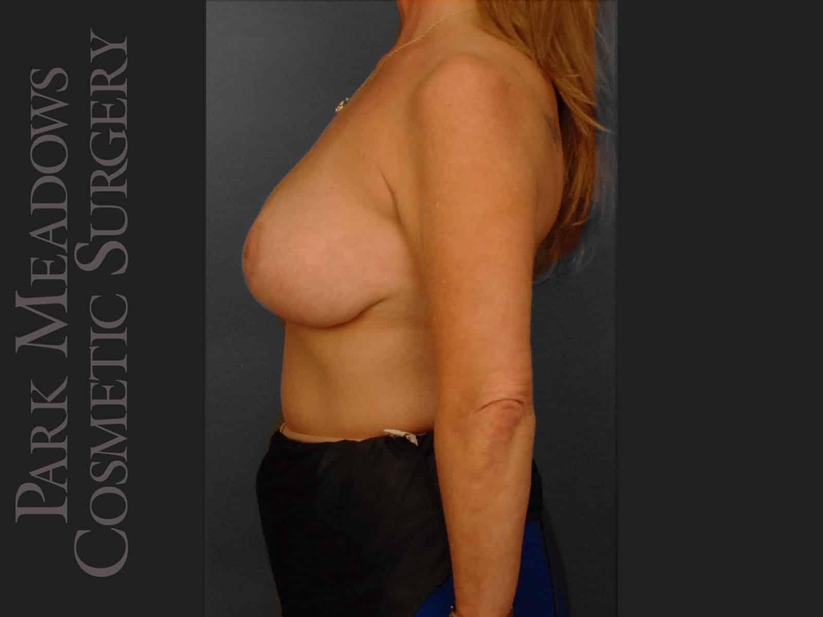 After Image: Mastopexy (Breast lift) - left-side