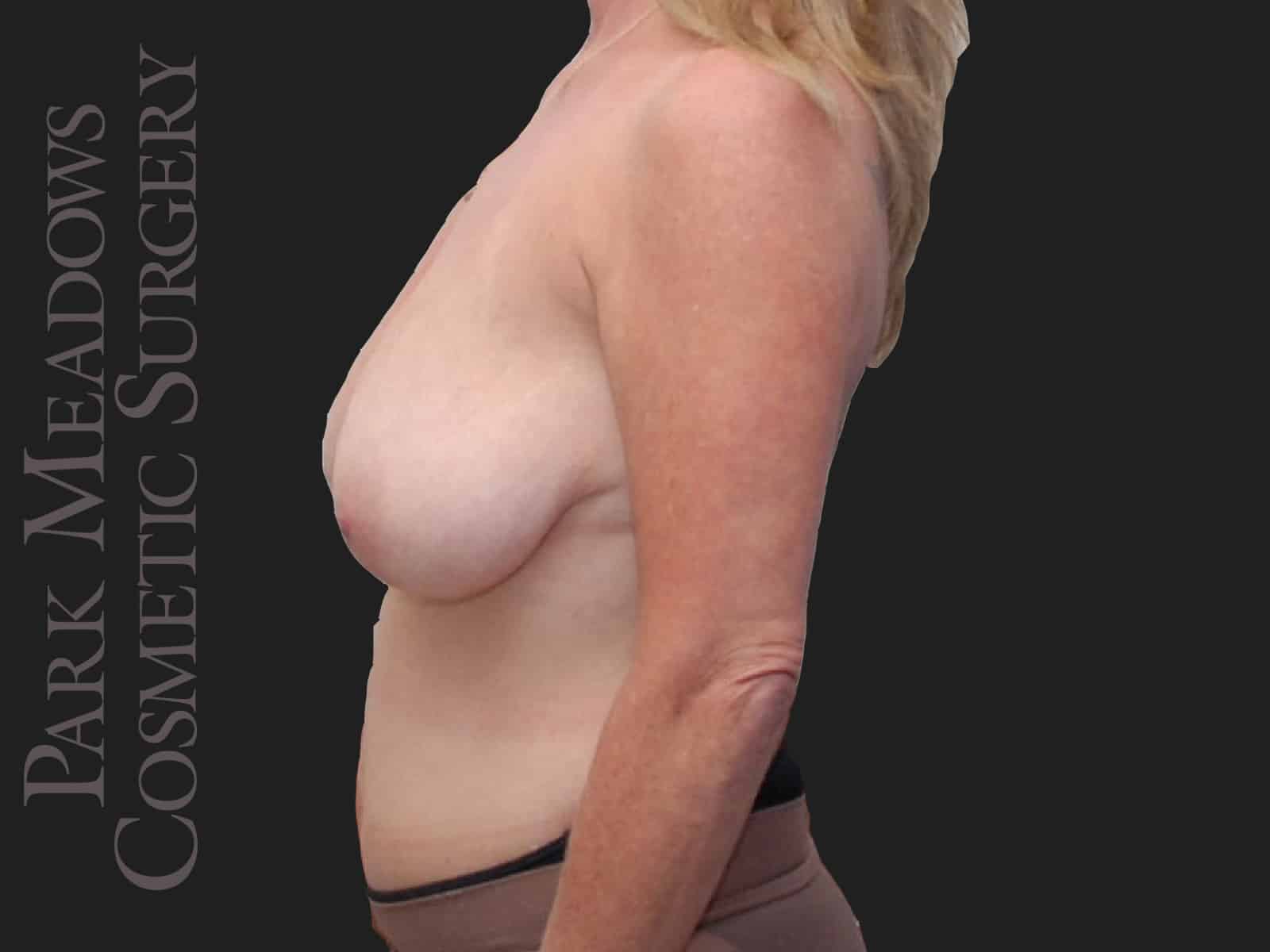 Before Image: Mastopexy (Breast lift) - left-side