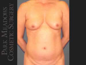 Tummy Tuck, Liposuction, and Breast Augmentation