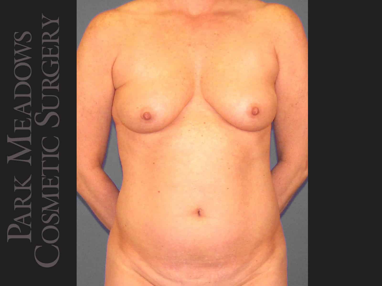 Before Image: Tummy Tuck, Liposuction, and Breast Augmentation - front