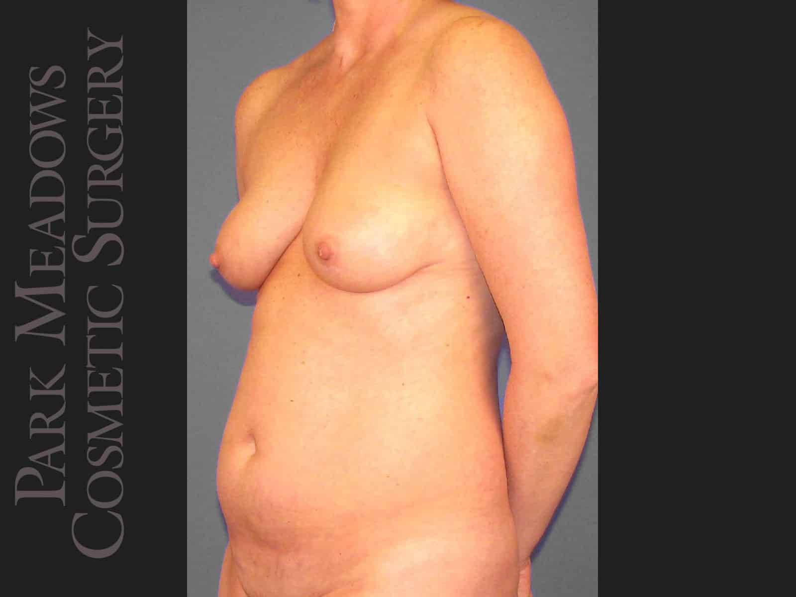 Before Image: Tummy Tuck, Liposuction, and Breast Augmentation - left-front-oblique