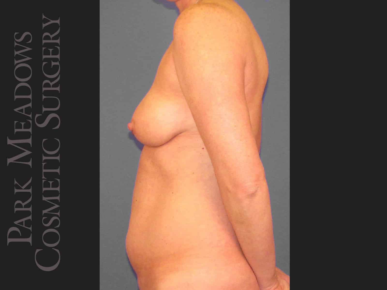 Before Image: Tummy Tuck, Liposuction, and Breast Augmentation - left-side