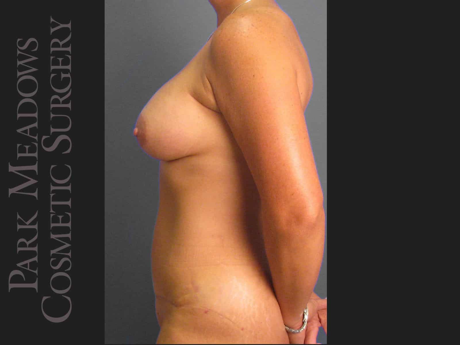 After Image: Tummy Tuck, Liposuction, and Breast Augmentation - left-side