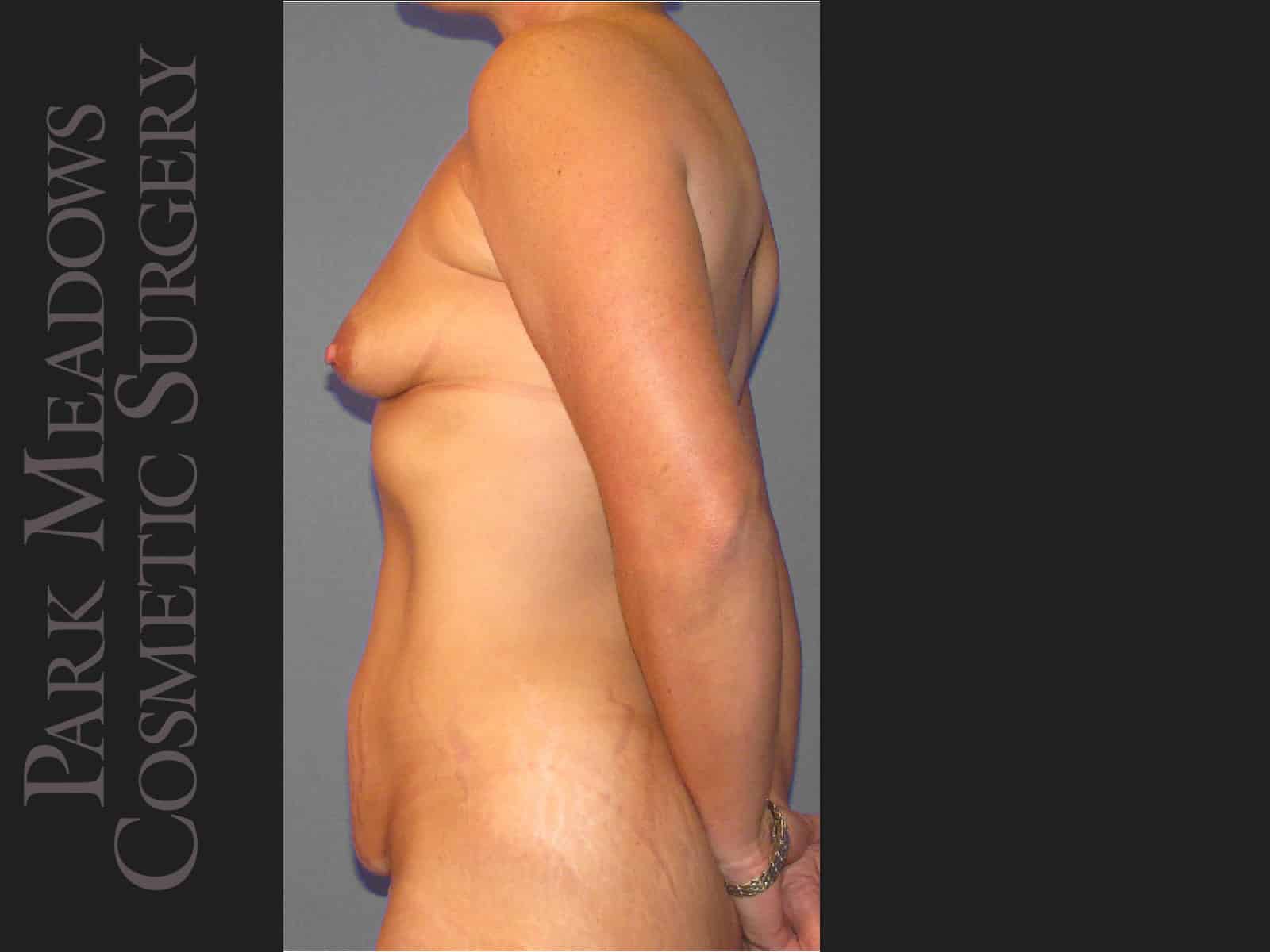Before Image: Tummy Tuck, Liposuction, and Breast Augmentation - left-side