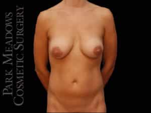 Tummy Tuck, Liposuction, and Breast Augmentation