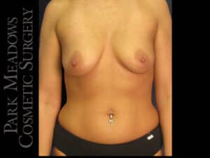 Tummy Tuck, Liposuction, and Breast Augmentation
