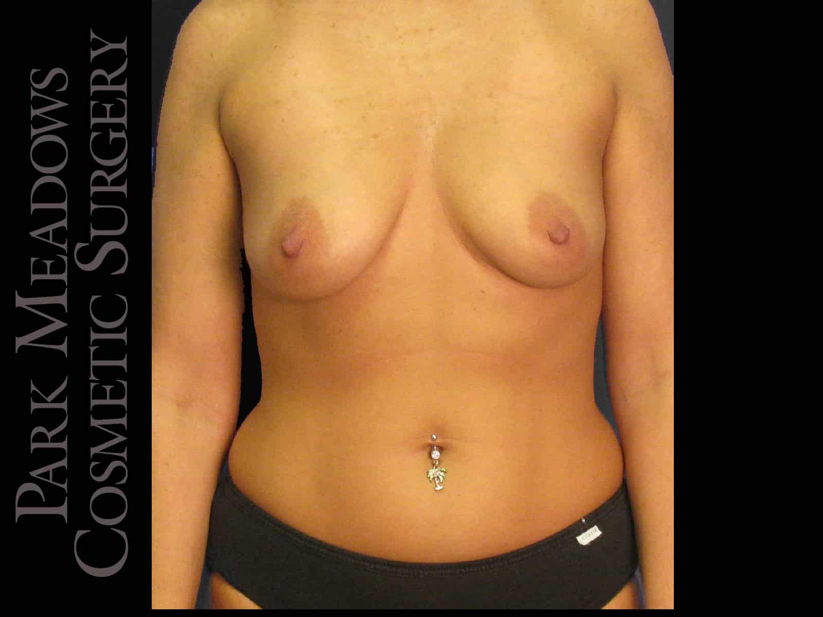Before Image: Tummy Tuck, Liposuction, and Breast Augmentation - front