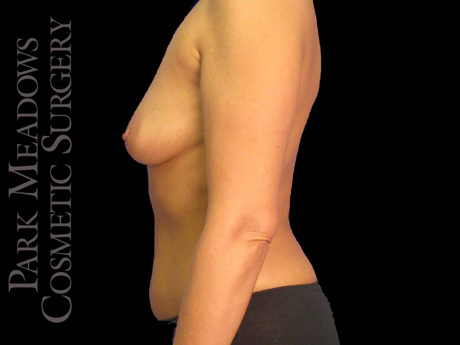 Before Image: Tummy Tuck, Liposuction, and Breast Augmentation - left-side