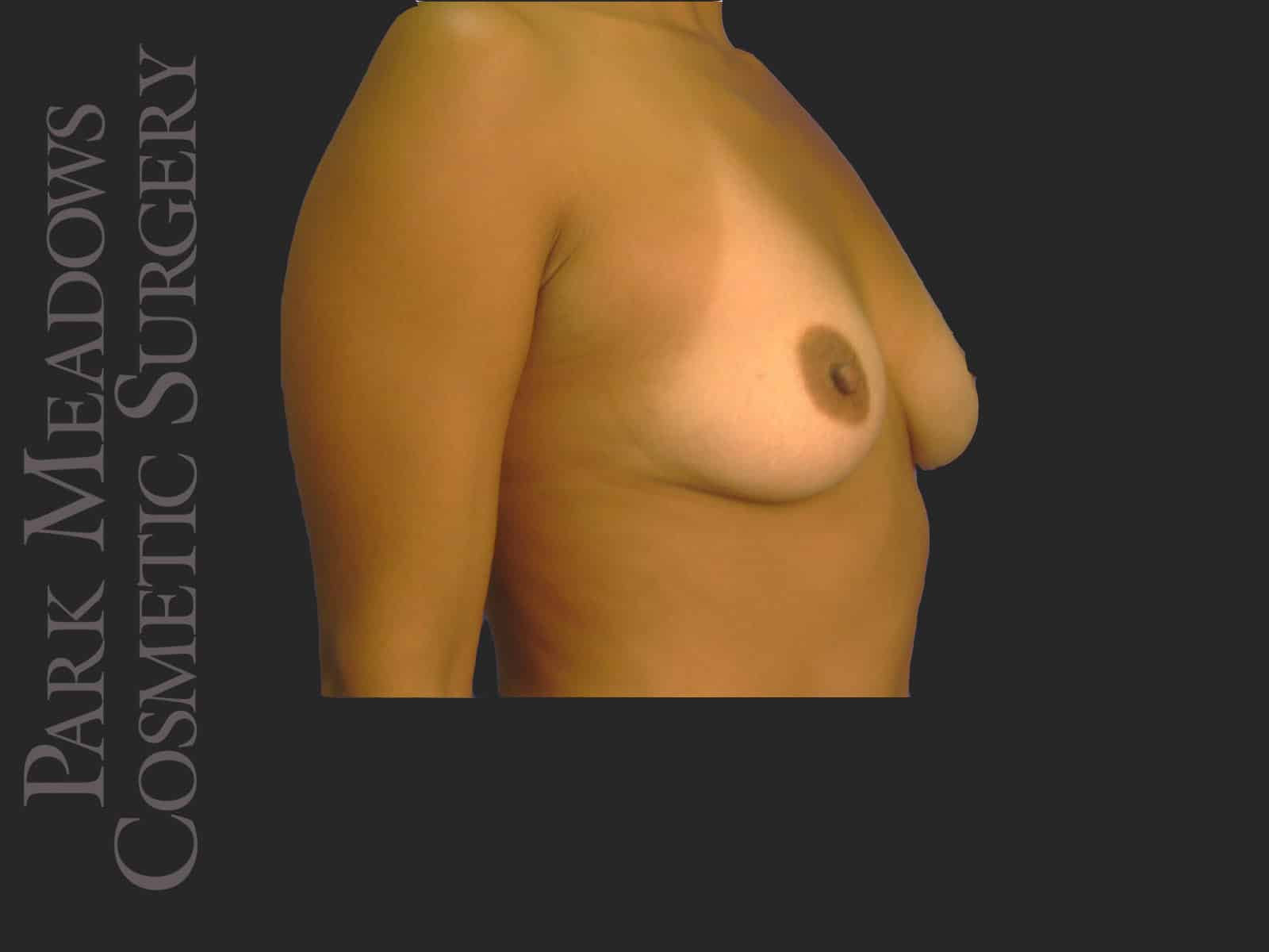 Before Image: Saline Breast Augmention; 325cc implant filled to 390cc - right-front-oblique
