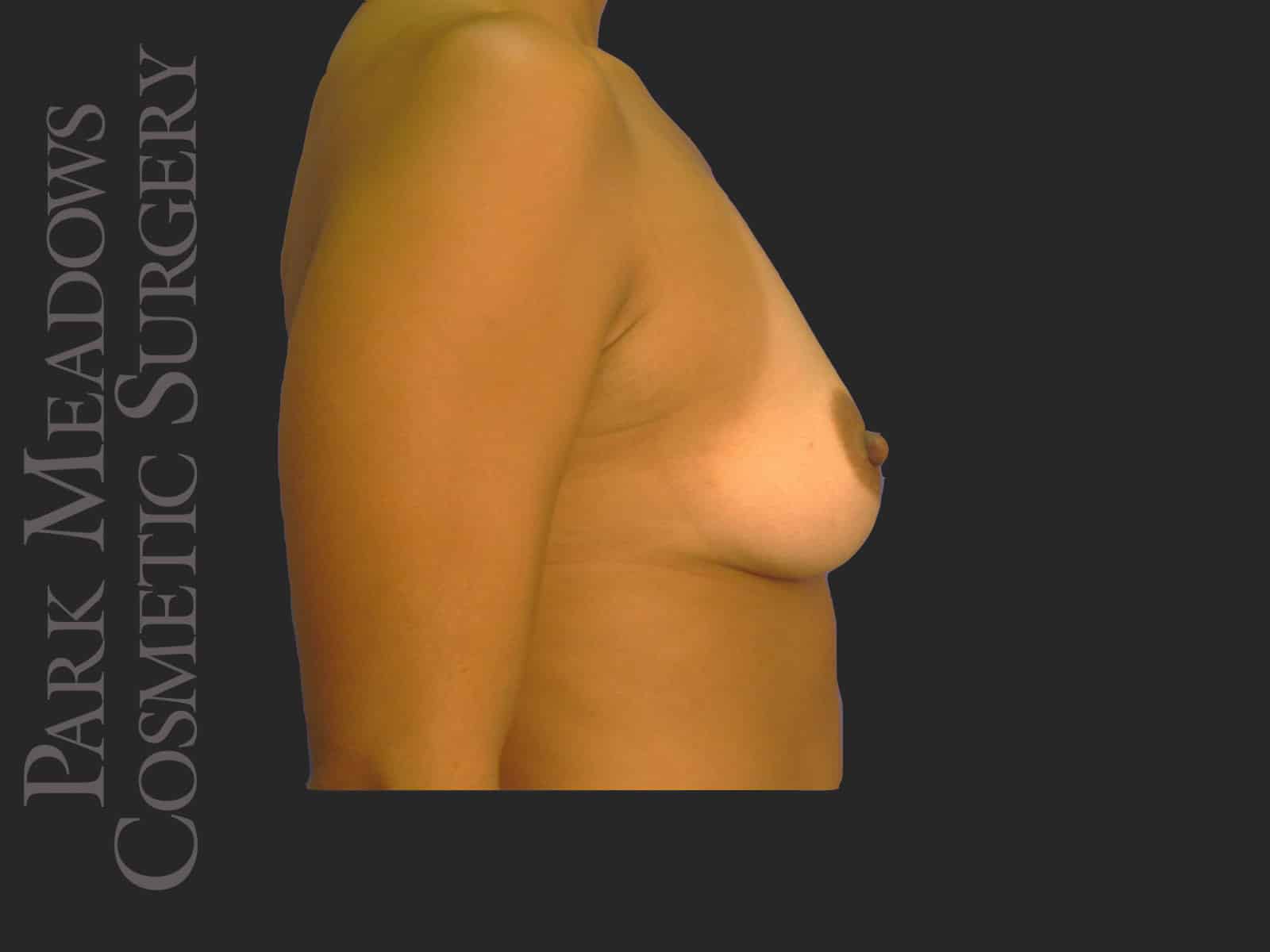 Before Image: Saline Breast Augmention; 325cc implant filled to 390cc - right-side