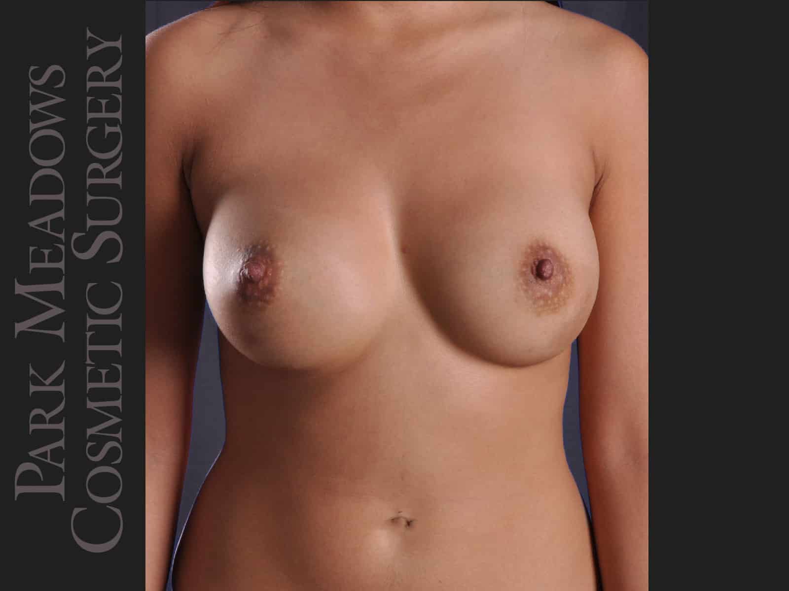 Saline Breast Augmention; (R) 300cc implants filled to 350cc & (L) 300cc implants  filled to 325cc