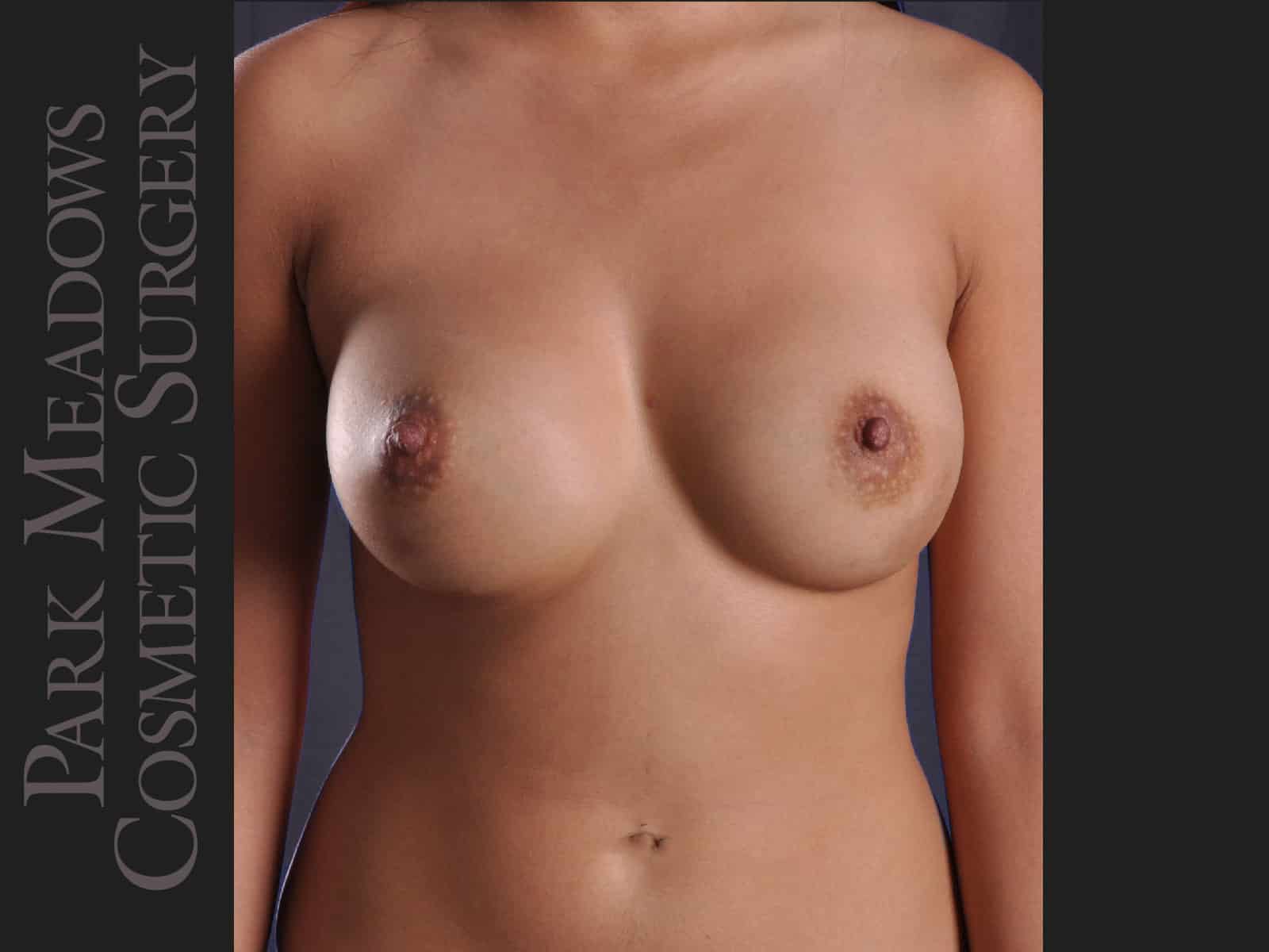After Image: Saline Breast Augmention; (R) 300cc implants filled to 350cc & (L) 300cc implants  filled to 325cc - front