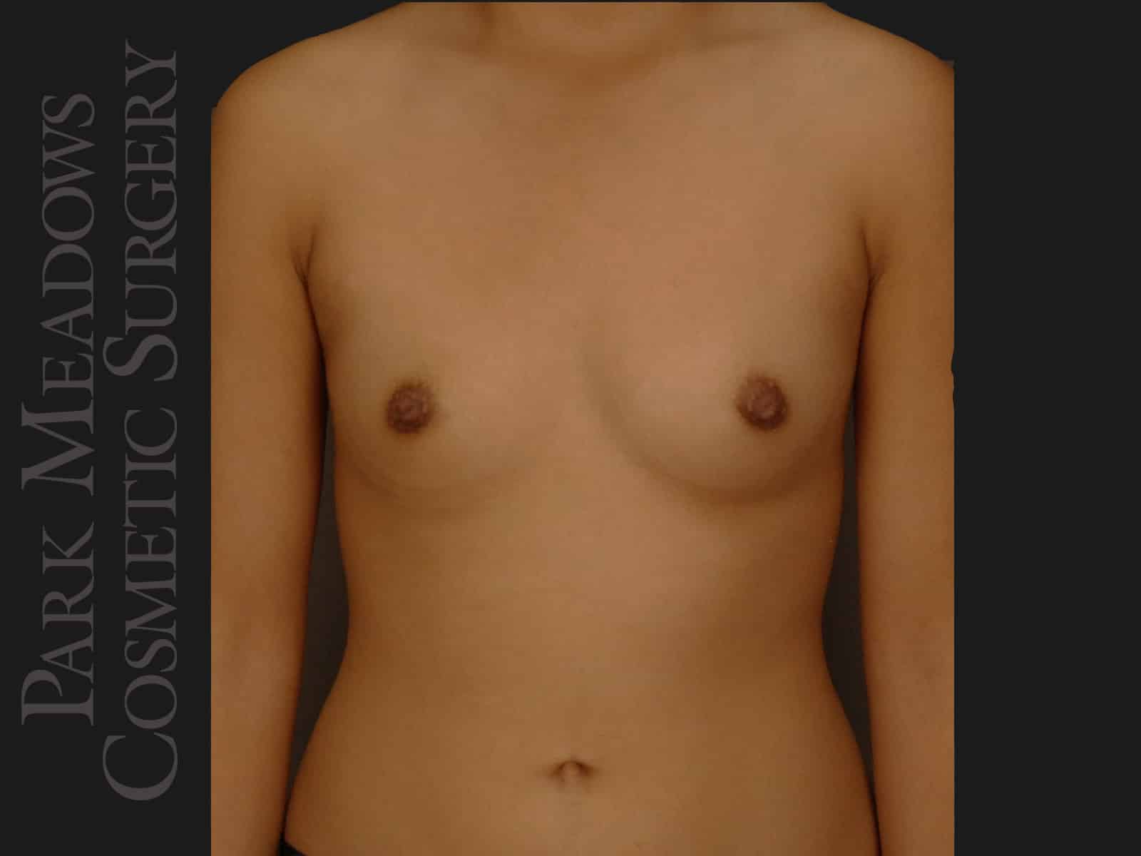 Before Image: Saline Breast Augmention; (R) 300cc implants filled to 350cc & (L) 300cc implants  filled to 325cc - front