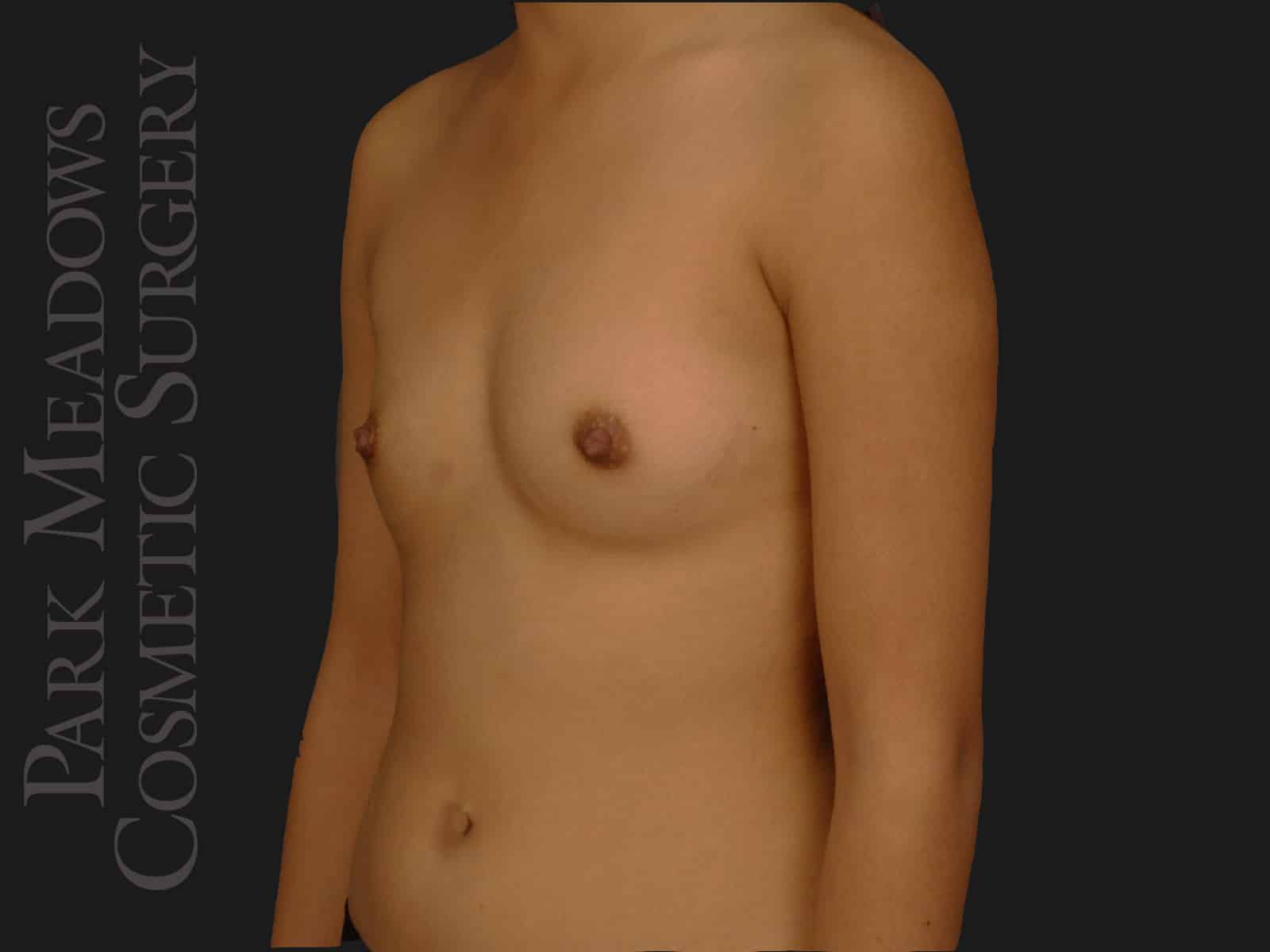 Before Image: Saline Breast Augmention; (R) 300cc implants filled to 350cc & (L) 300cc implants  filled to 325cc - left-front-oblique