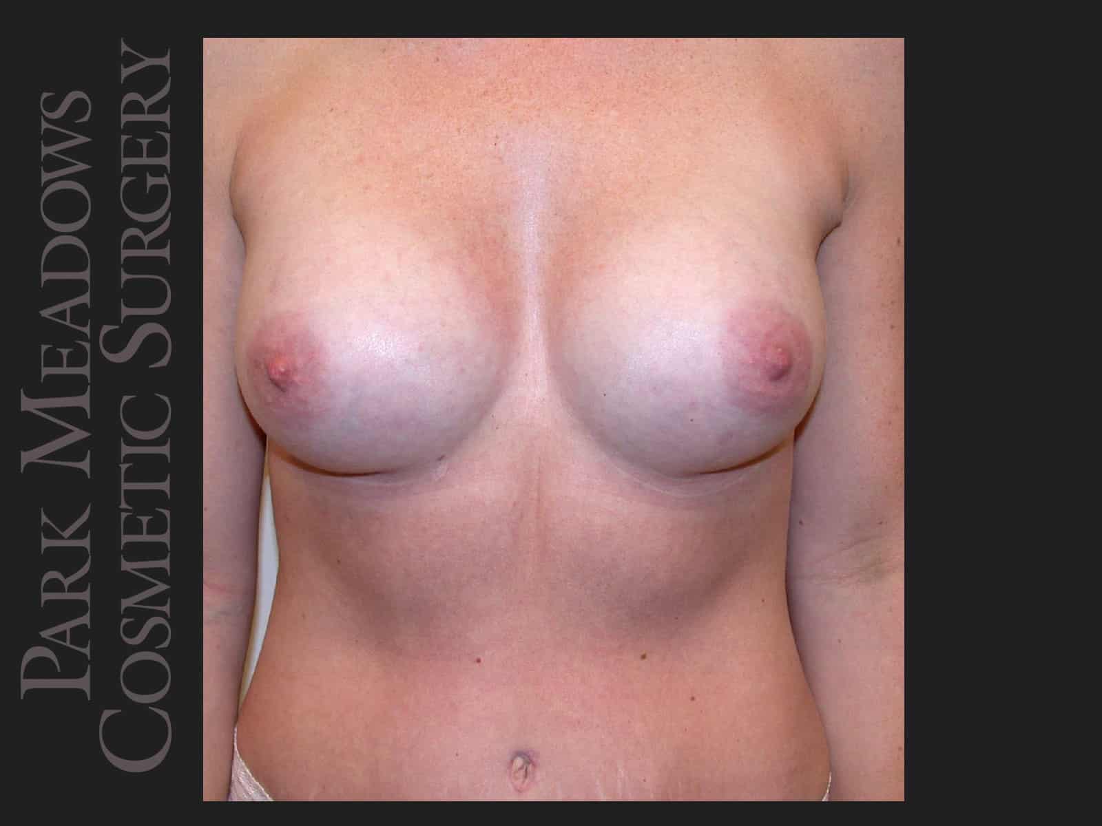 After Image: Saline Breast Augmention; 250cc implants filled to 300cc - front