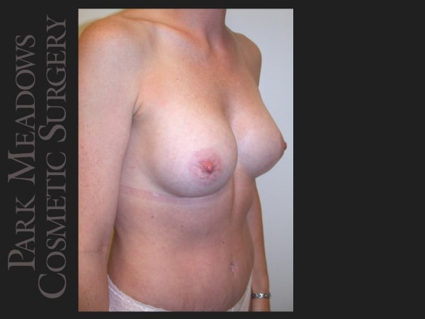 After Image: Saline Breast Augmention; 250cc implants filled to 300cc - right-front-oblique