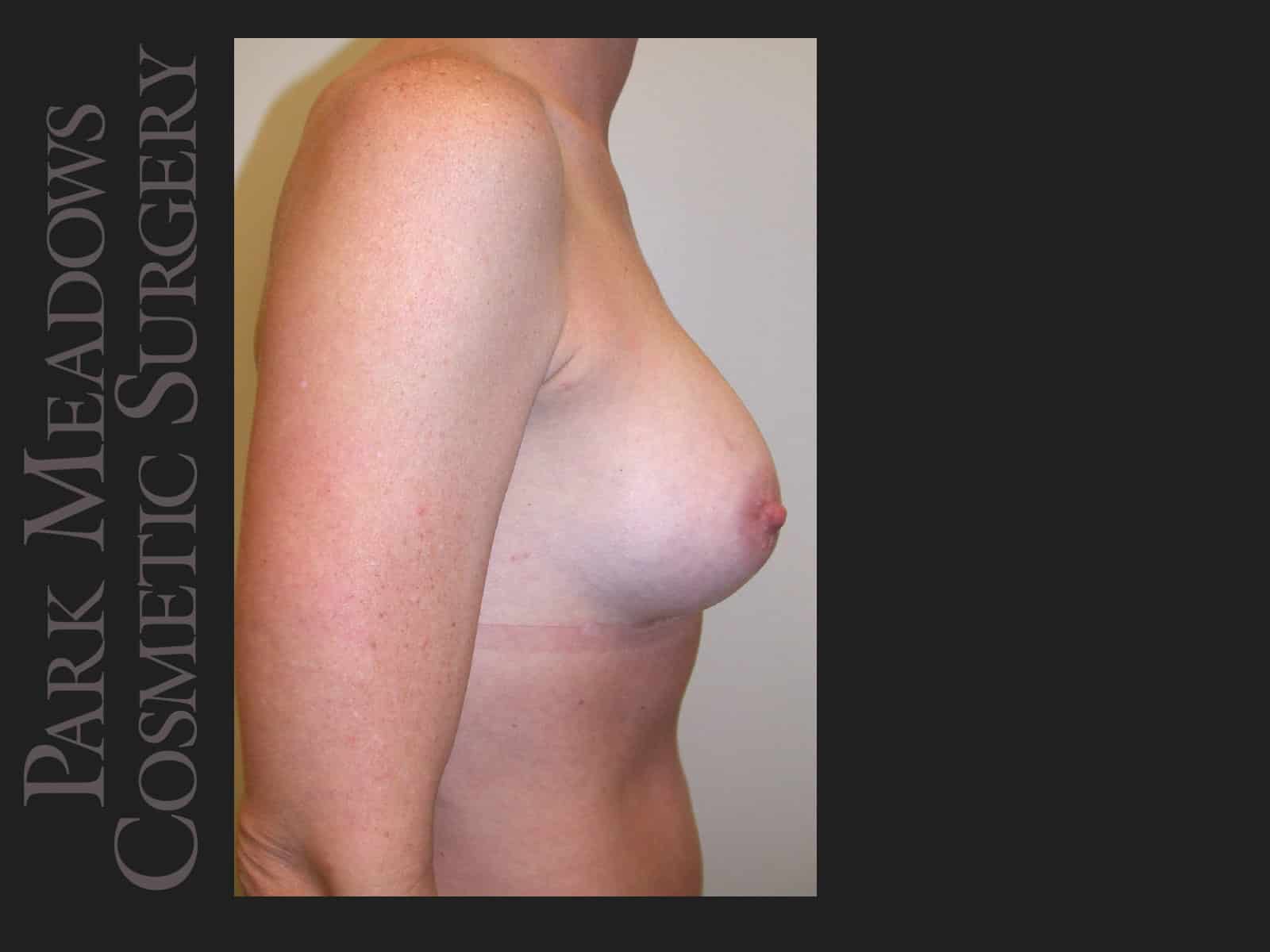 After Image: Saline Breast Augmention; 250cc implants filled to 300cc - right-side