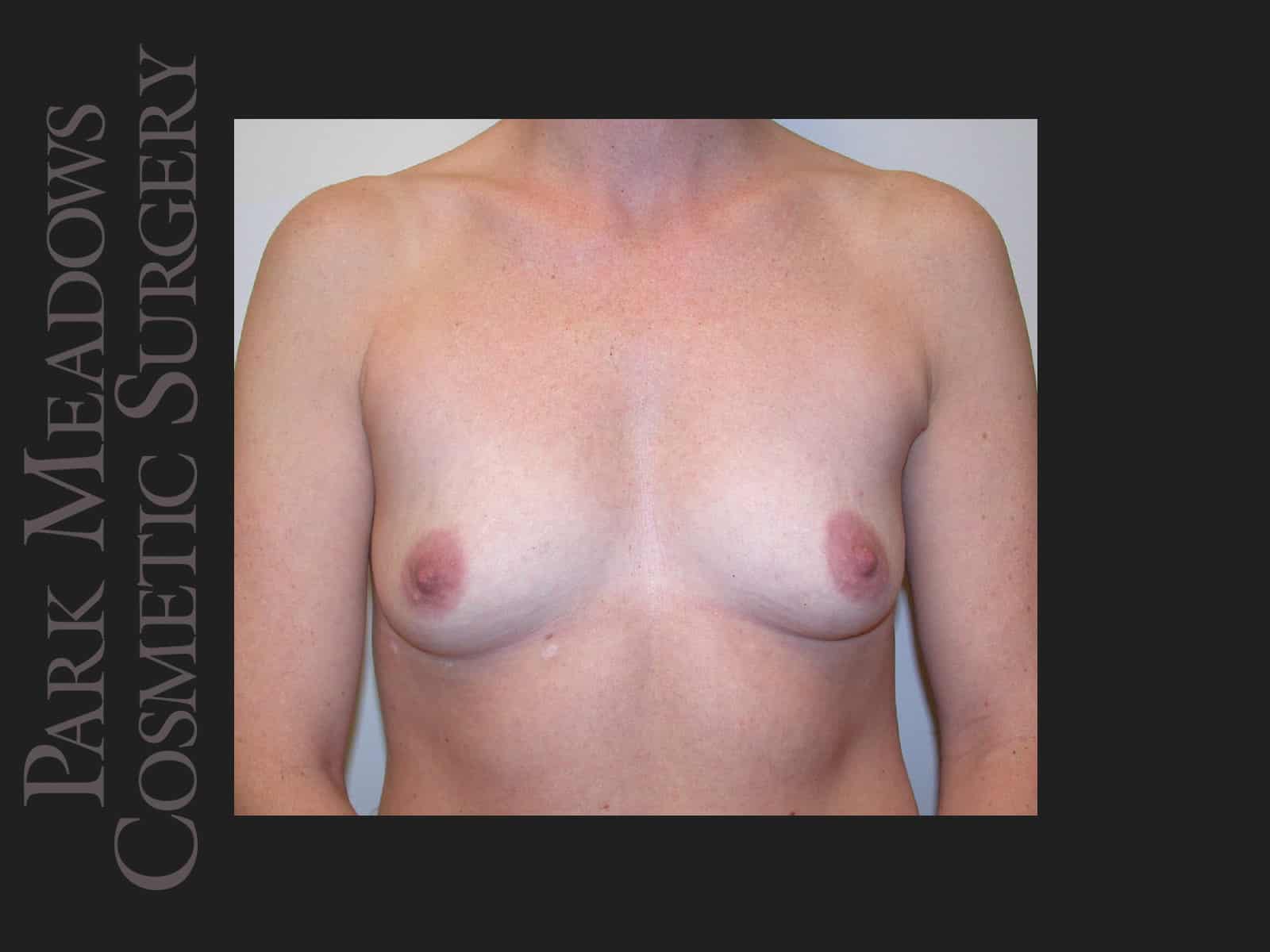 Before Image: Saline Breast Augmention; 250cc implants filled to 300cc - front