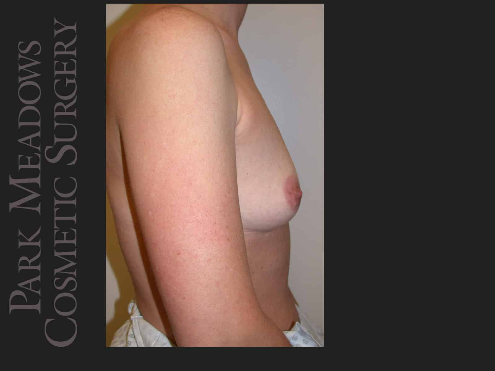 Before Image: Saline Breast Augmention; 250cc implants filled to 300cc - right-side