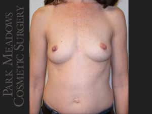 Saline Breast Augmention; 250cc implants filled to 275cc