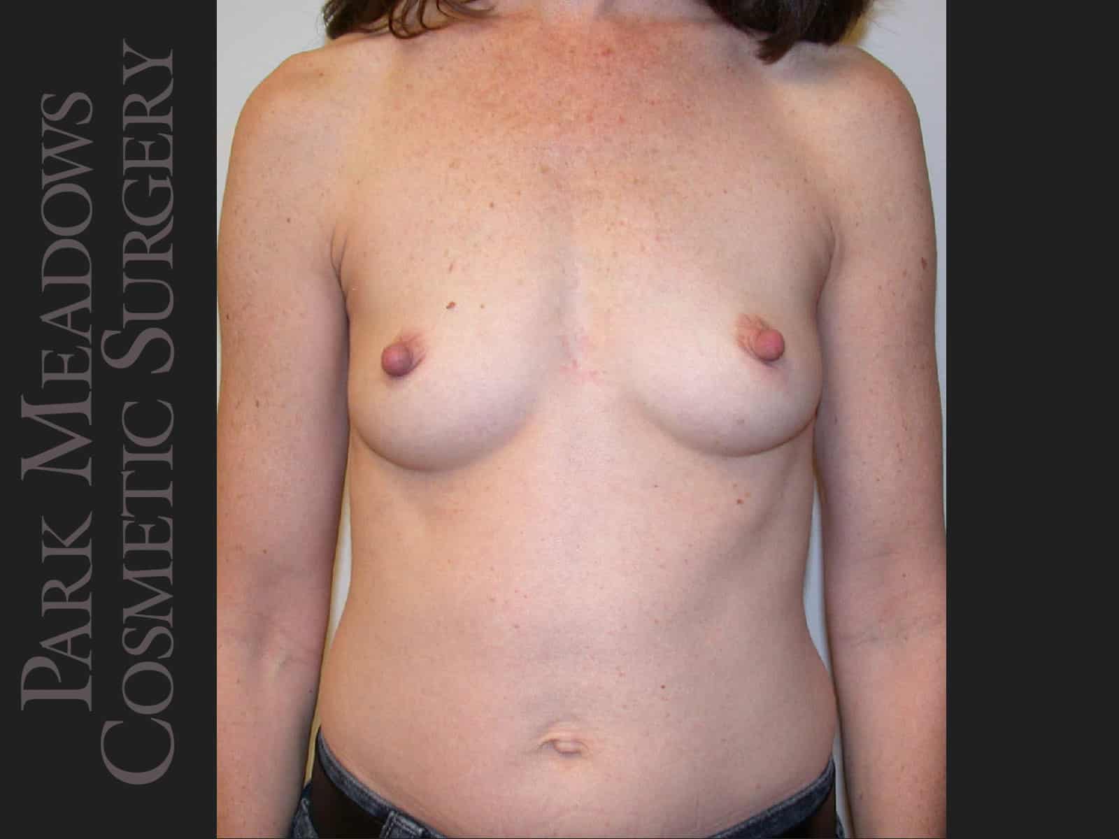Before Image: Saline Breast Augmention; 250cc implants filled to 275cc - front