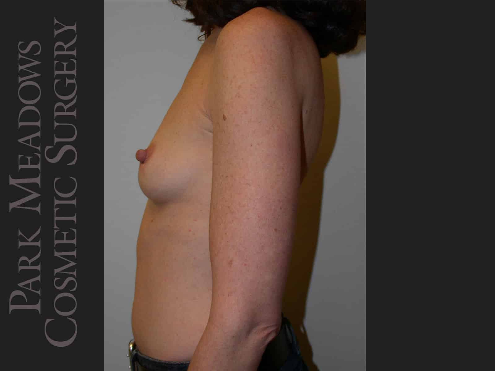 Before Image: Saline Breast Augmention; 250cc implants filled to 275cc - left-side