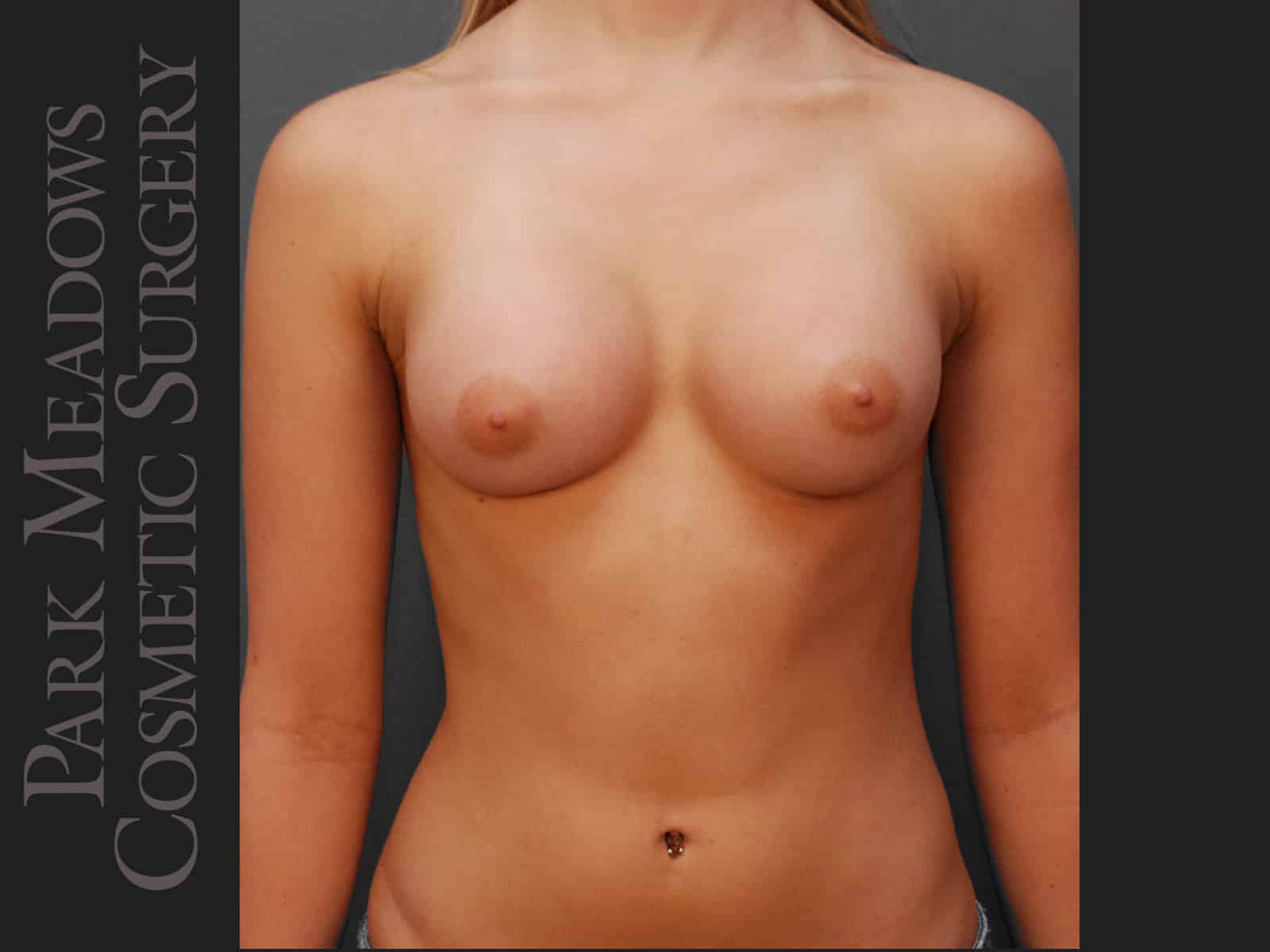 After Image: Saline Breast Augmention; 250cc implants filled to 275cc - front