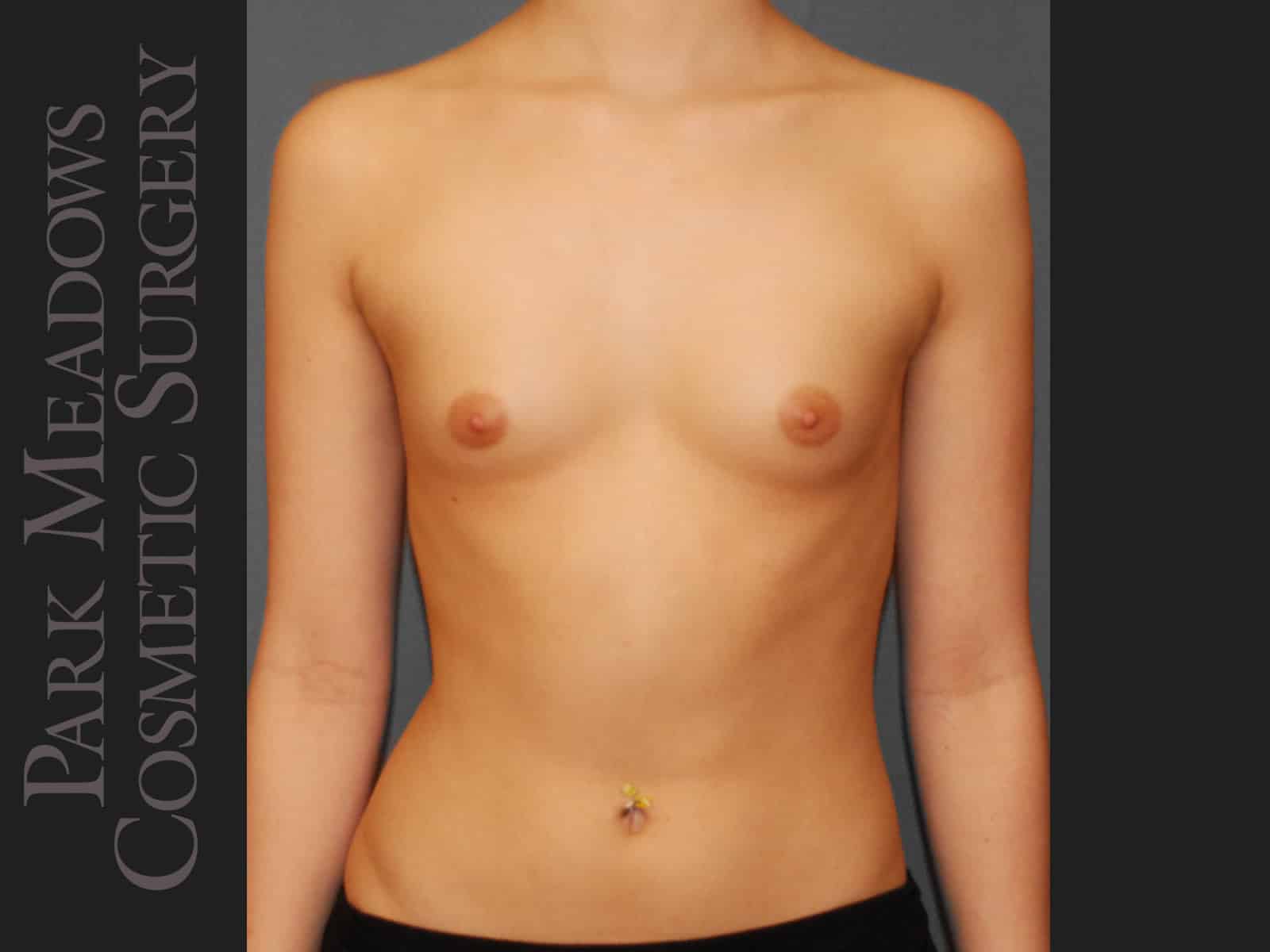 Before Image: Saline Breast Augmention; 250cc implants filled to 275cc - front