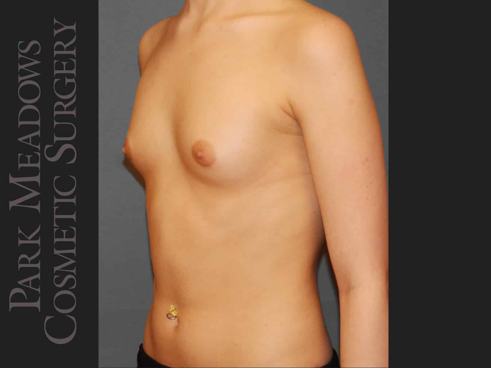 Before Image: Saline Breast Augmention; 250cc implants filled to 275cc - left-front-oblique