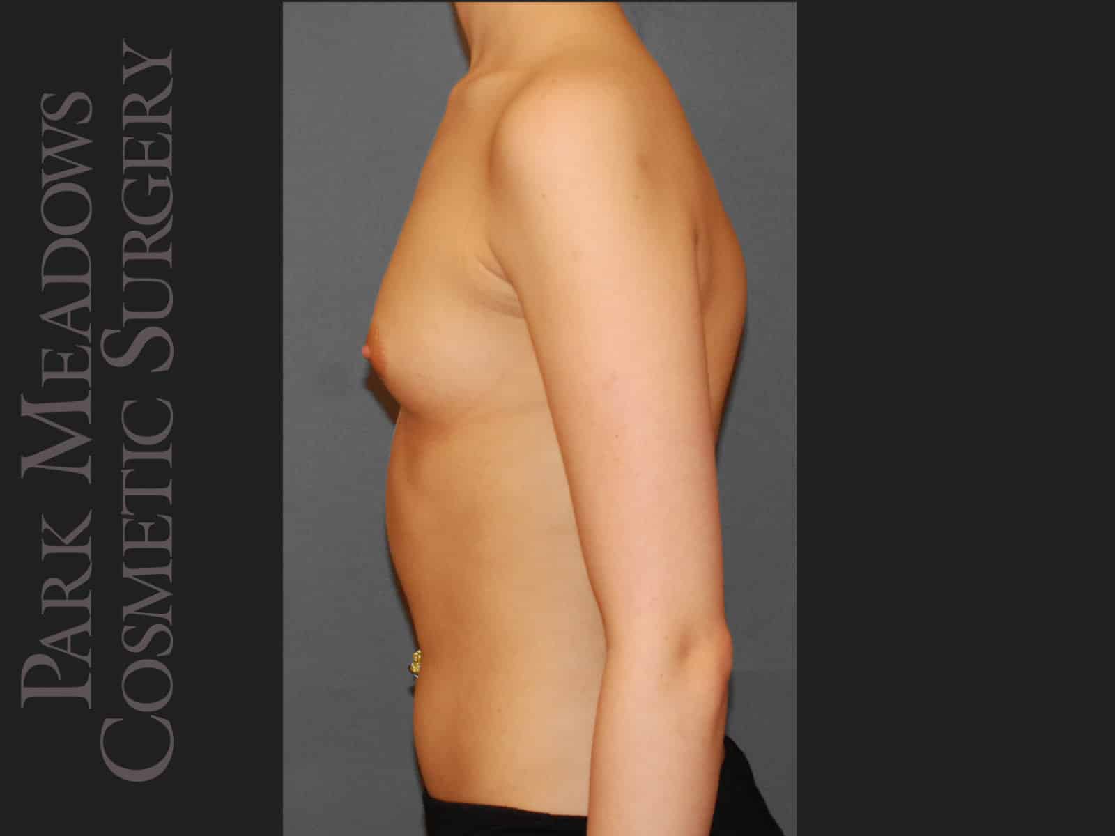 Before Image: Saline Breast Augmention; 250cc implants filled to 275cc - left-side