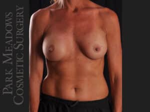 Silicone Breast Augmentation