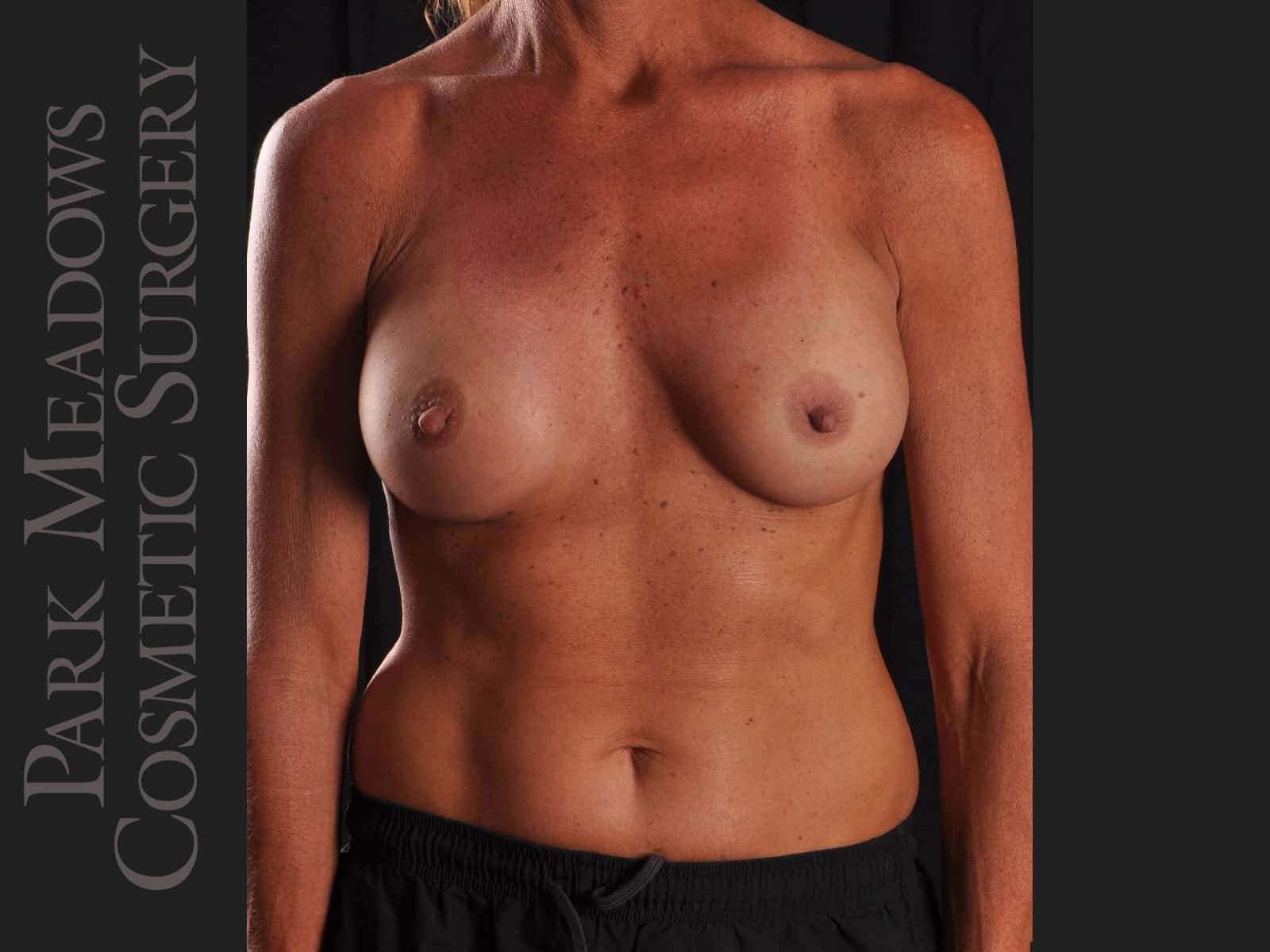 After Image: Silicone Breast Augmentation - front
