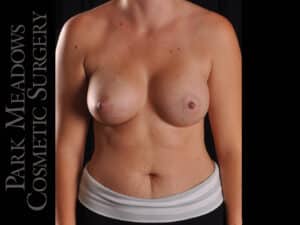 Silicone Breast Augmentation