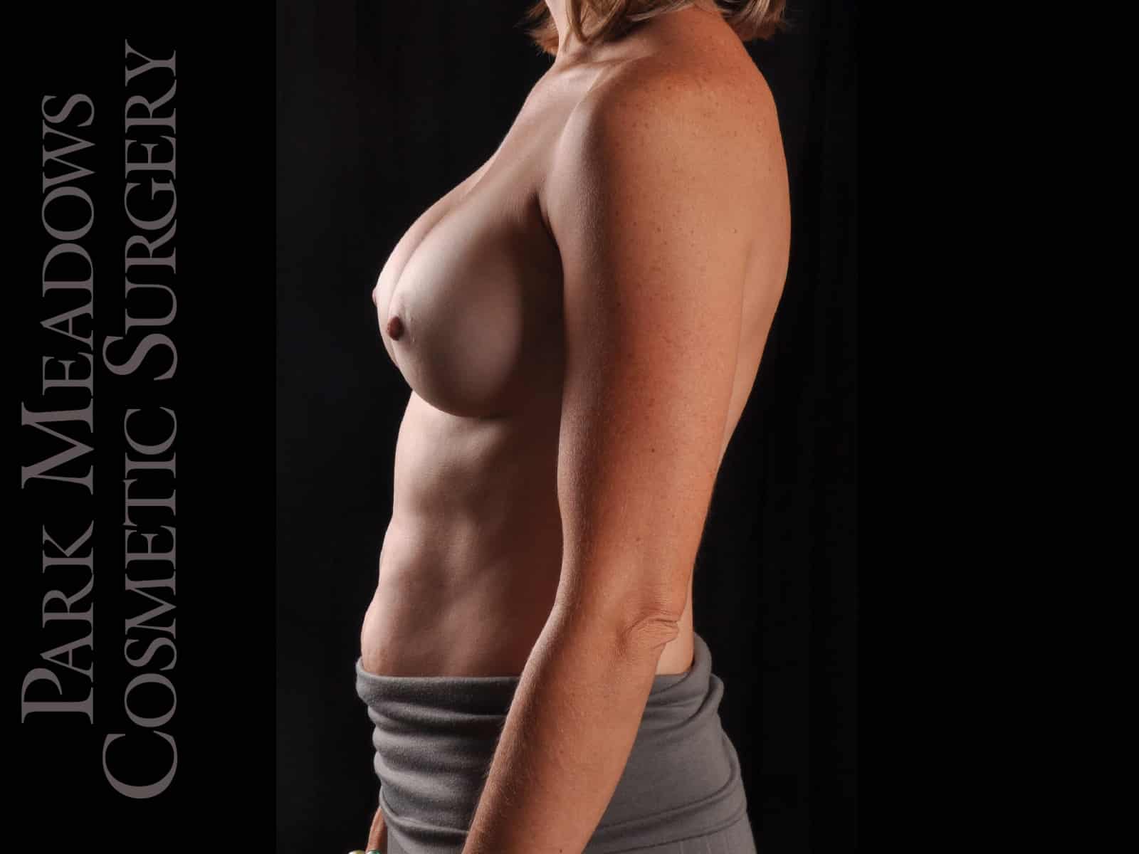 After Image: Silicone Breast Augmentation - left-side
