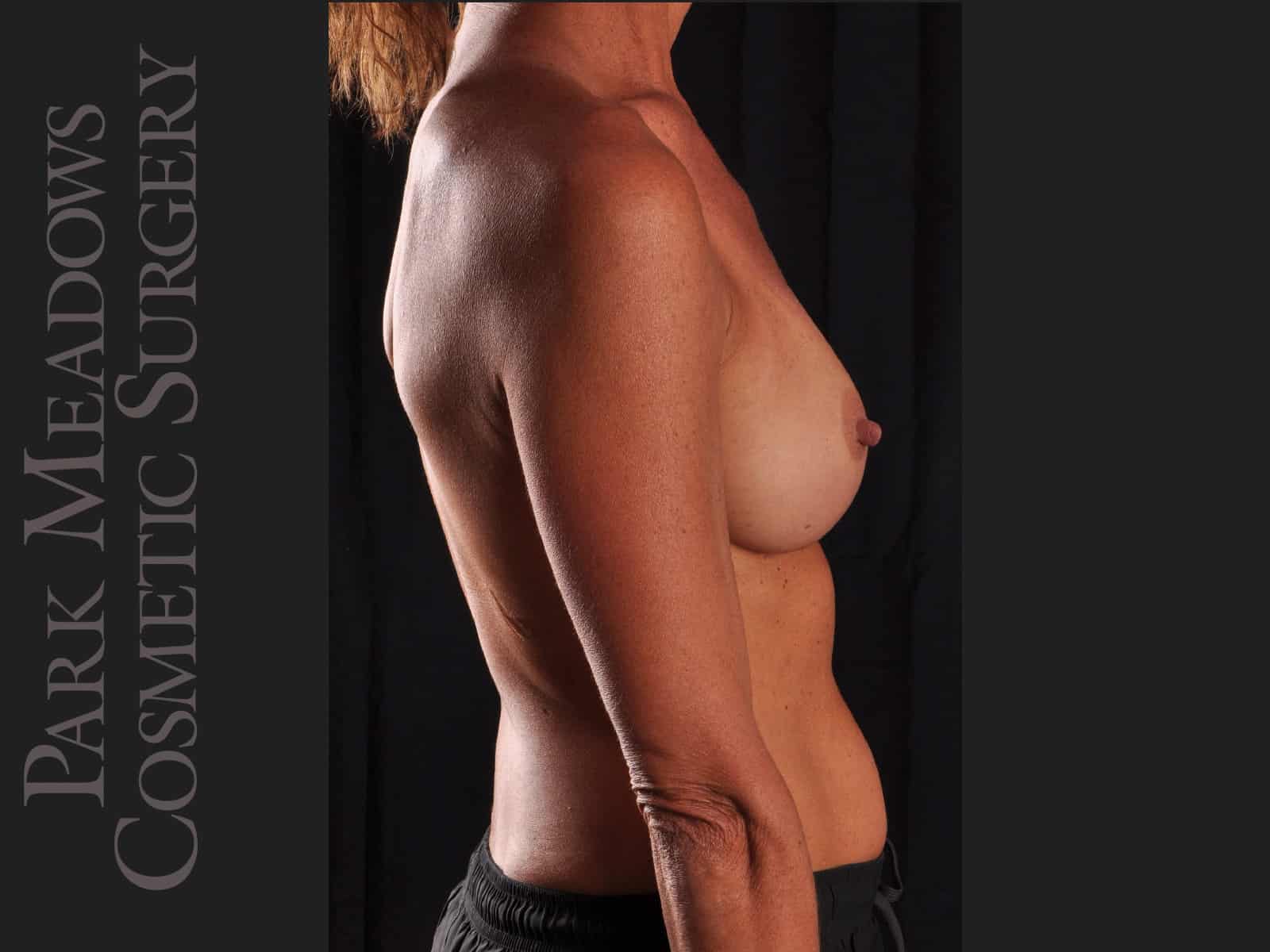 After Image: Silicone Breast Augmentation - right-side