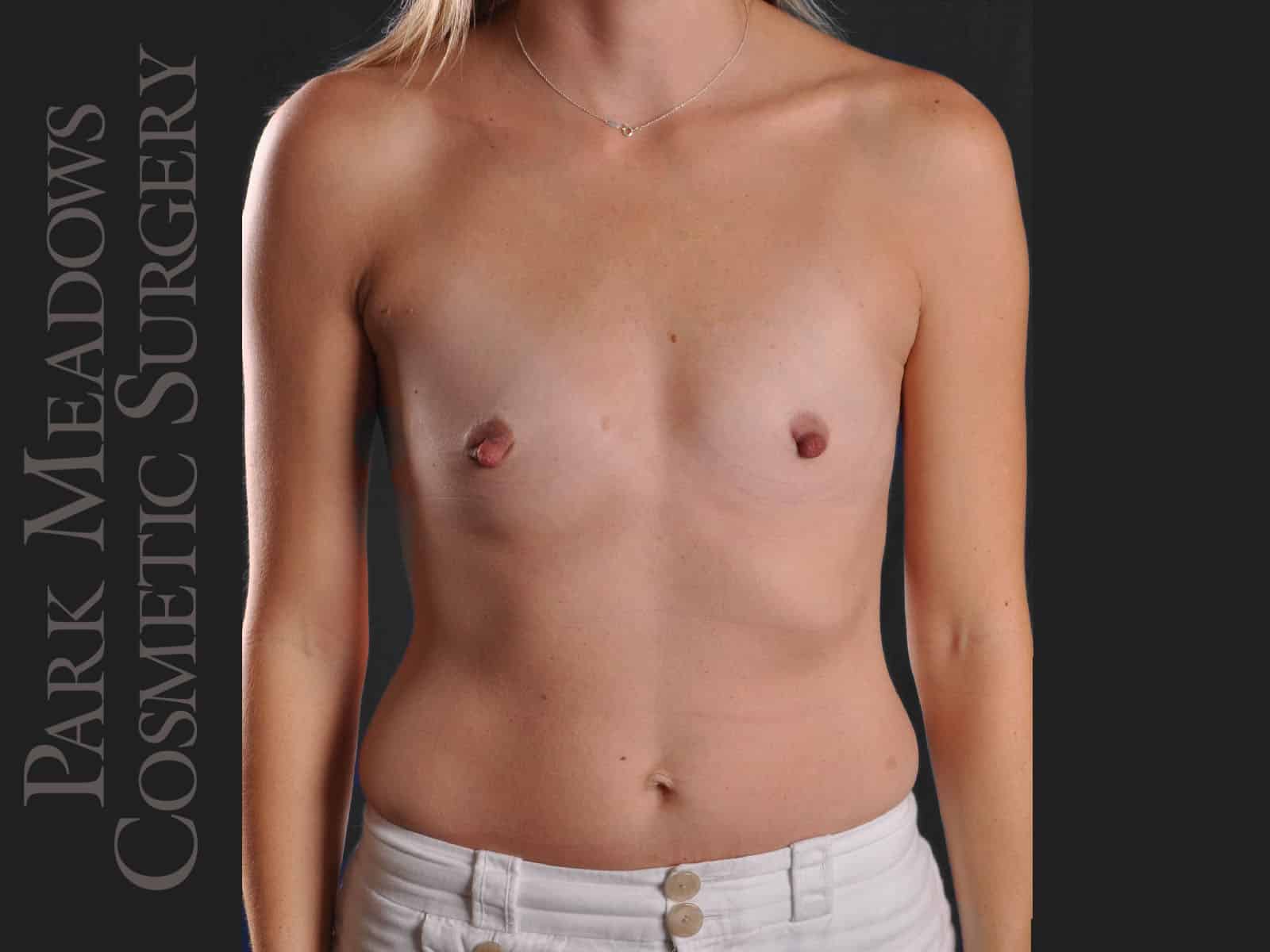 Before Image: Silicone Breast Augmentation - front