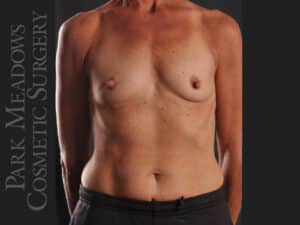 Silicone Breast Augmentation