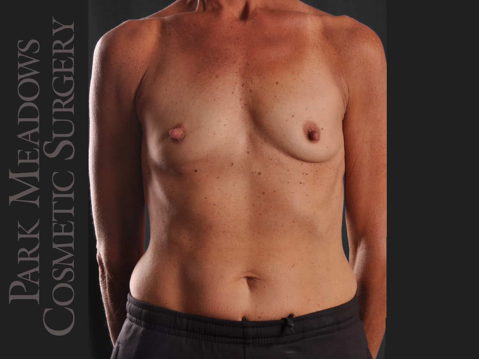 Before Image: Silicone Breast Augmentation - front