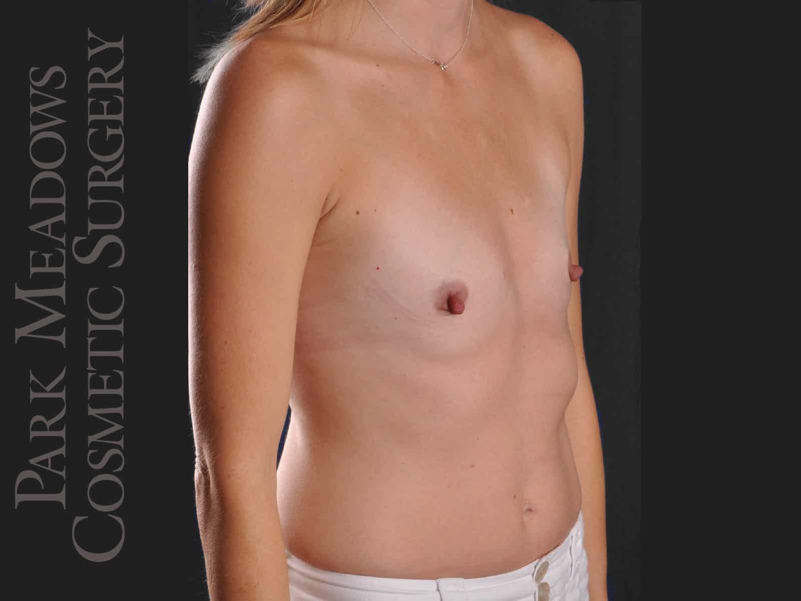 Before Image: Silicone Breast Augmentation - right-front-oblique