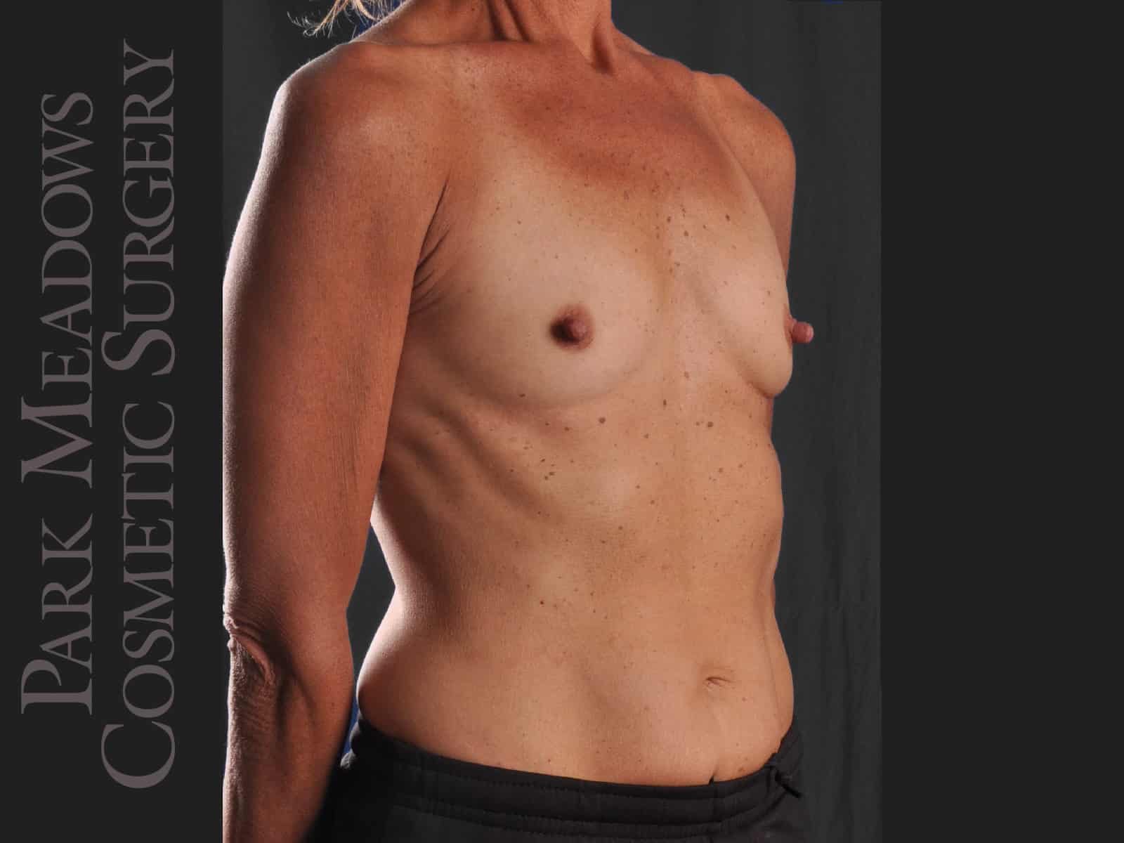 Before Image: Silicone Breast Augmentation - right-front-oblique