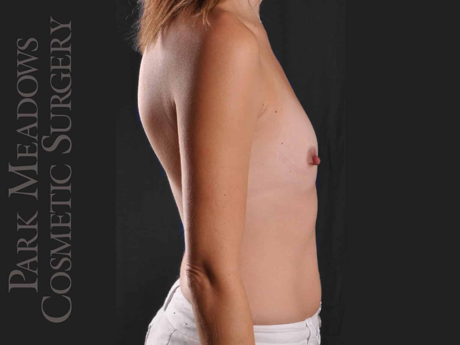 Before Image: Silicone Breast Augmentation - right-side