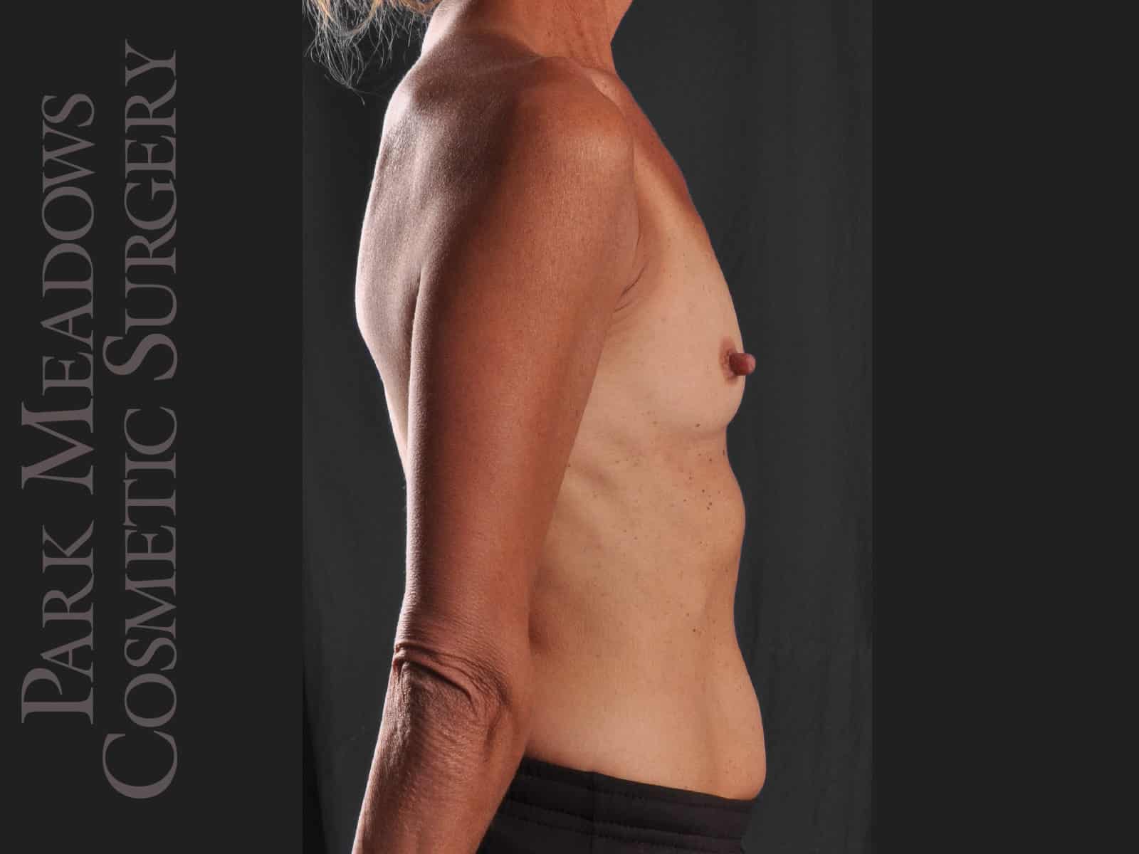 Before Image: Silicone Breast Augmentation - right-side