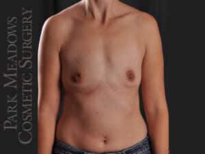 Silicone Breast Augmentation